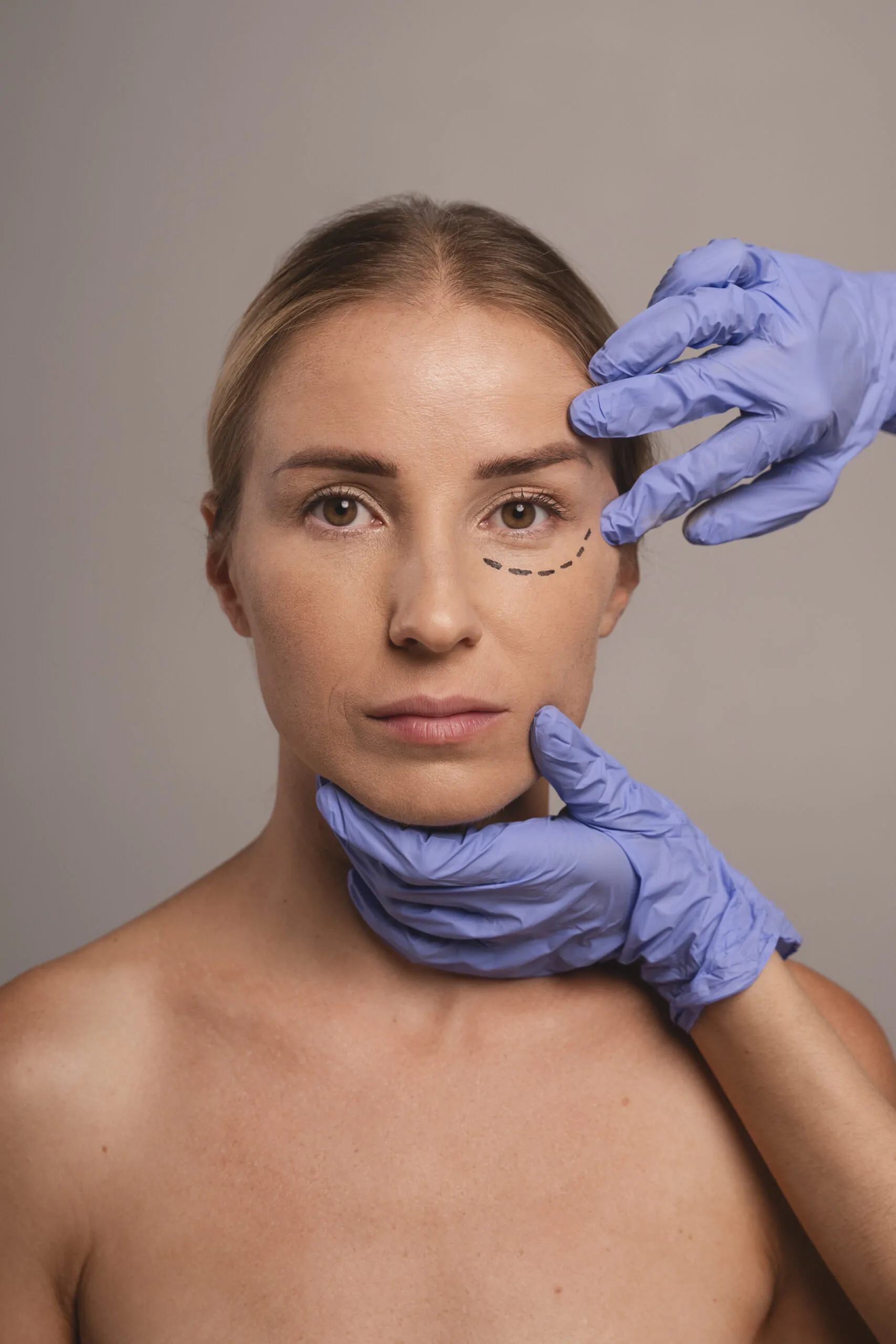 Blefaroplastia